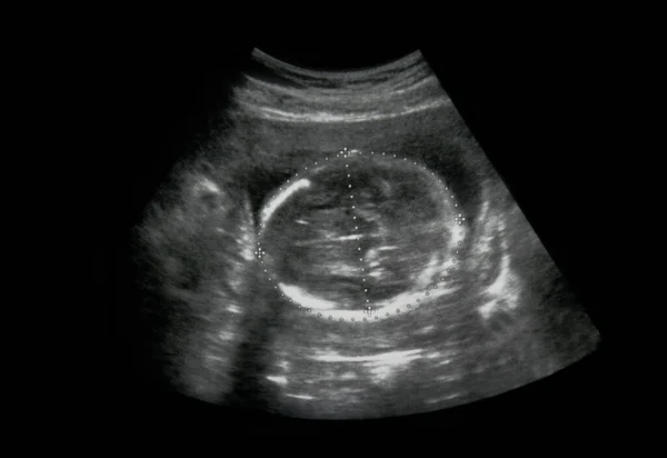 Bebeğin ultrasonu anne karnında..