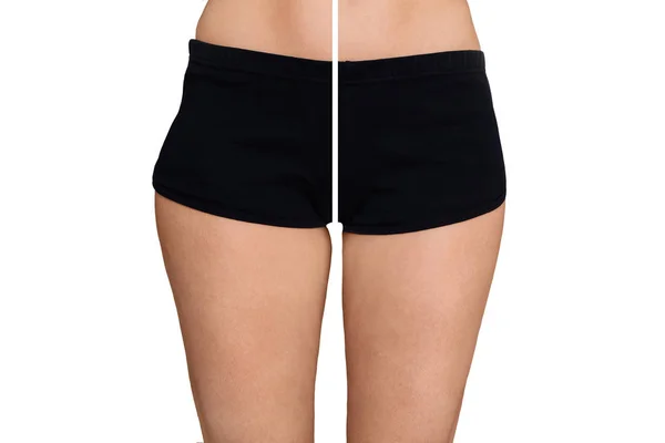Kvinnlig skinkor före och efter behandling. Jämförelse av kvinnliga ben lår med och utan celluliter. Hudproblem, kroppsvård, övervikt och bantning koncept — Stockfoto