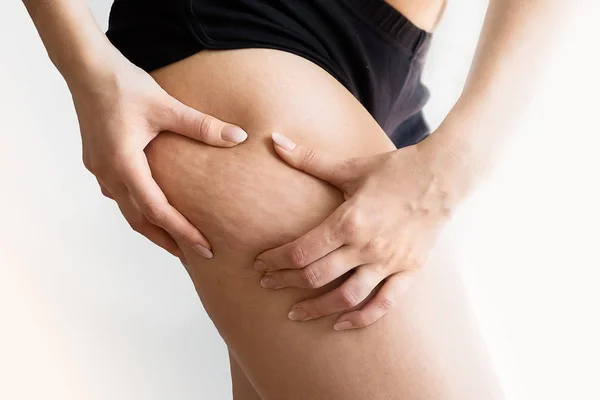 Ragazza mostra tenendo e spingendo la pelle delle gambe cellulite, buccia d'arancia. Trattamento e smaltimento del peso in eccesso, la deposizione di tessuto adiposo sottocutaneo — Foto Stock