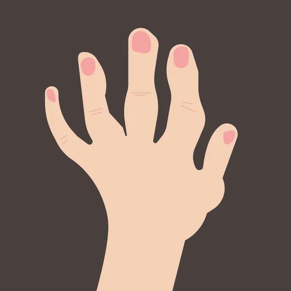 Rheumatoid polyarthritis of hands — Stock Vector