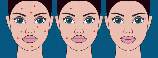 Female face with pimples — Stock Vector