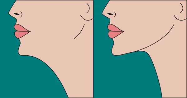 Çift çene düzeltme, plastik cerrahi, çene önce ve sonra yüz dağılımı. Vektör çizim