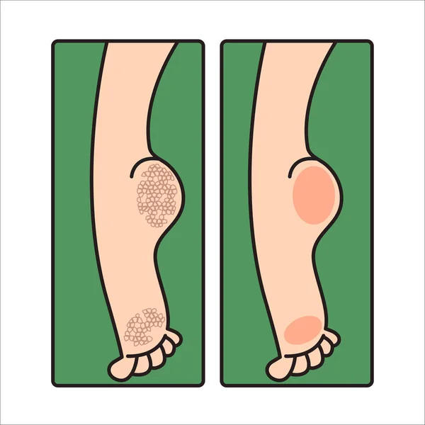 乾燥のひびの入った女性の足 — ストックベクタ
