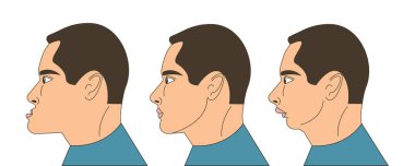 Mesial and distral bite, man with malocclusion, lower jaw extended forward, lower jaw pushed back, bite correction by braces. Vector illustration clipart