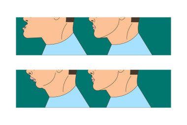 Mesial ve ısırmak, maloklüzyon, adamla distral alt çene ileri, ısırık düzeltme parantez tarafından genişletilmiş. Vektör çizim