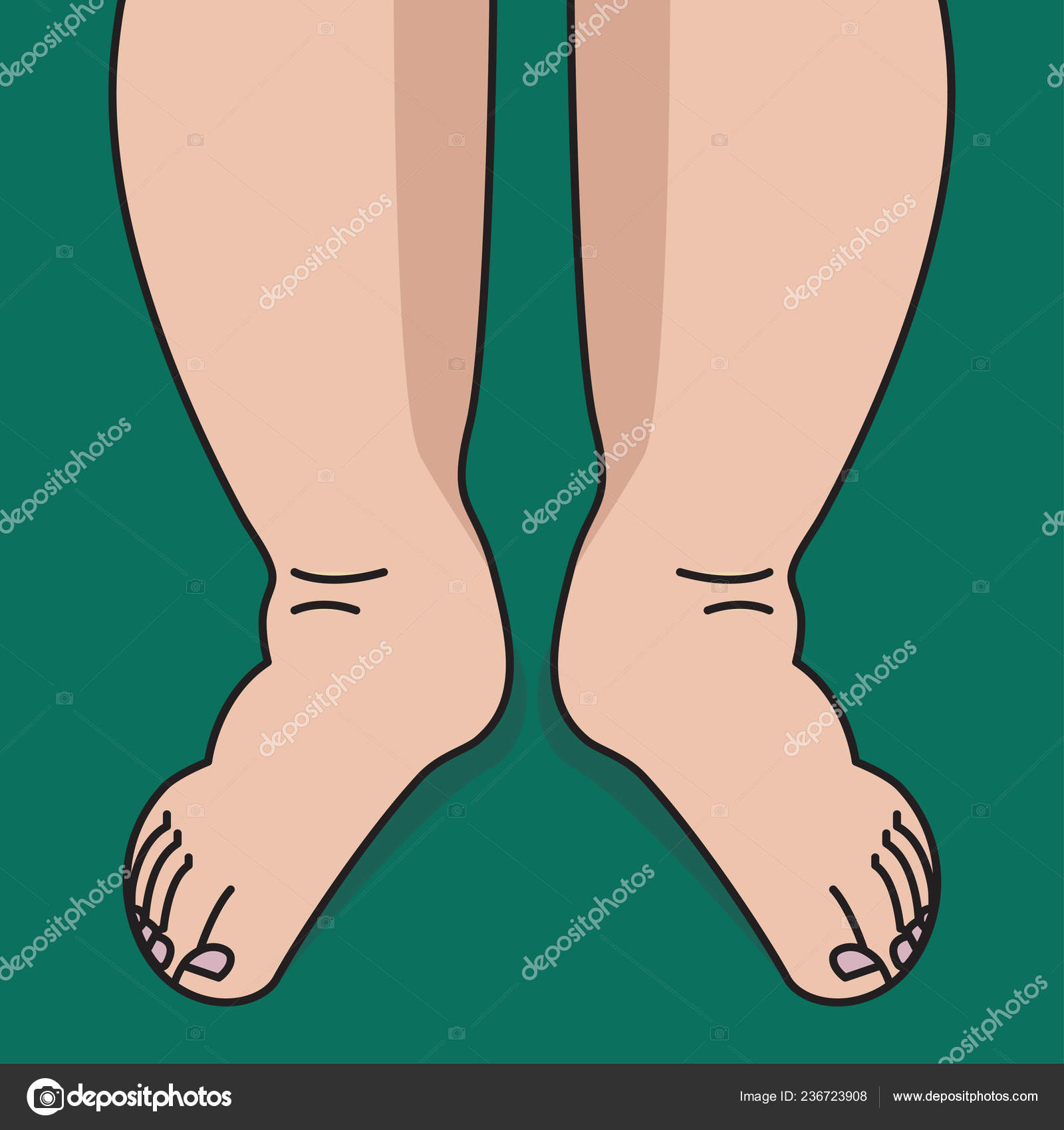 Ayudan ¿Las piernas hinchazón? la elevadas a