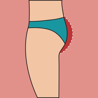 Kadın kalça öncesi ve sonrası düzeltme implantları, alt düz kıçını problemini spor çalışmaları, şeklini değiştirme. Vektör çizim