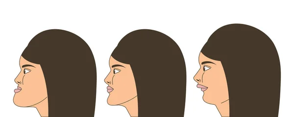 Mesial ve distral ısırık, kadın maloklüzyon, alt çene ile ileri, geri, ısırık düzeltme parantez tarafından itti alt çene genişletilmiş. Vektör çizim