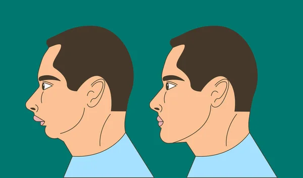Morsure Distale Homme Avec Malocclusion Mâchoire Inférieure Repoussant Correction Morsure — Image vectorielle