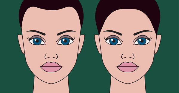 Hair transplantation in women