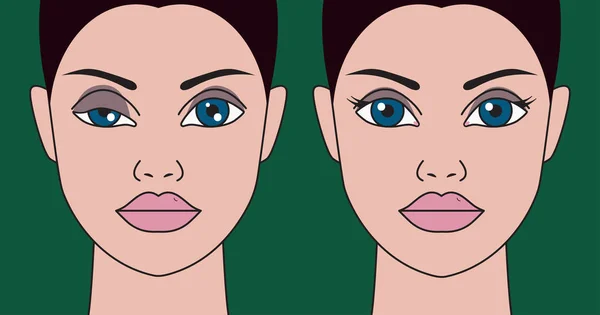 Ptosis Del Párpado Mujer Asimetría Los Ojos Cirugía Plástica Corrección — Archivo Imágenes Vectoriales