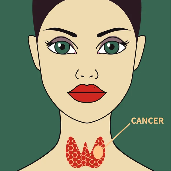 Schilddrüsenkrebs bei Frau — Stockvektor