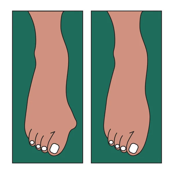 Valgo alluce, deformazione del piede — Vettoriale Stock