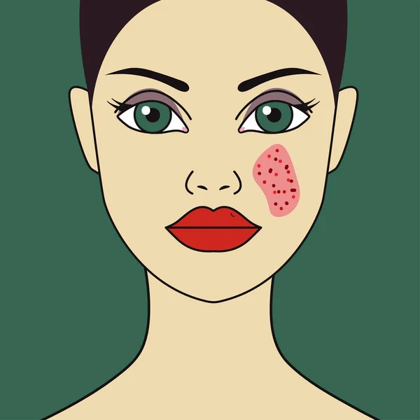 Woman with eczema on face — 스톡 벡터