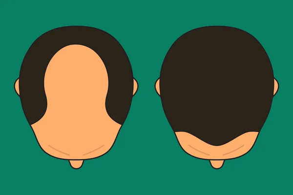 男性与秃头 — 图库矢量图片