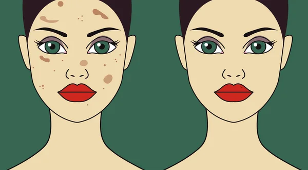 Pigmentflecken im weiblichen Gesicht — Stockvektor