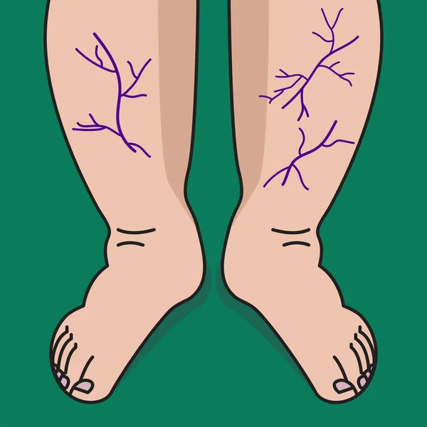 Venas Varicosas Las Piernas Mujer Venas Recipientes Sobre Espinillas — Vector de stock