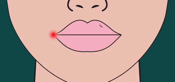 Herpes Lip Red Inflammation Lip Woman Vector Illustration — Stock Vector