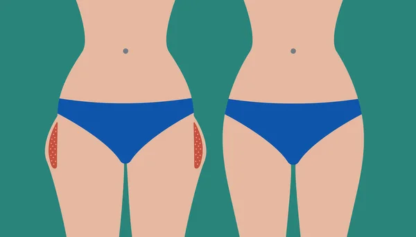Liposuccion des hanches, correction des hanches avant et après — Image vectorielle