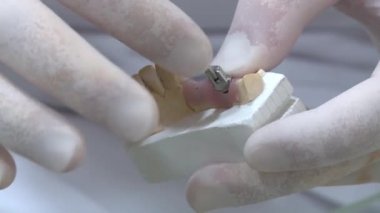 Diş hekimi diş izini alır. İmplantlarda işe yarıyor. Parantez değiştir