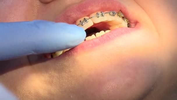 Stomatologul Amprentă Dinţi Lucrează Implanturi Schimba Aparatele Dentare — Videoclip de stoc