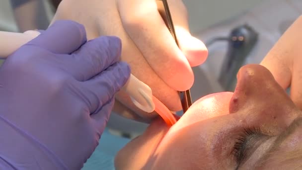 牙科医生把牙齿印出来 植入物方面的工作 更换支架 — 图库视频影像