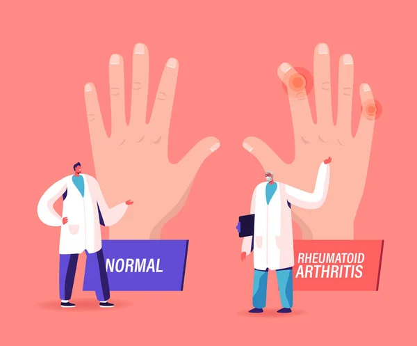 Artrite reumatoide Concetto di malattia. Medico Artrologo Punto sulla mano enorme con articolazioni malattia di Colleague Concilium — Vettoriale Stock