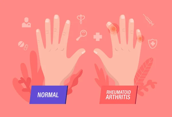 Mains normales et malades avec polyarthrite rhumatoïde, arthrose. Articulations des doigts Inflammation Medical Healthcare Concept. — Image vectorielle