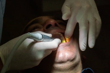 Diş kontrolü sırasında dişlerini muayene ettiren adamın yakın çekimi