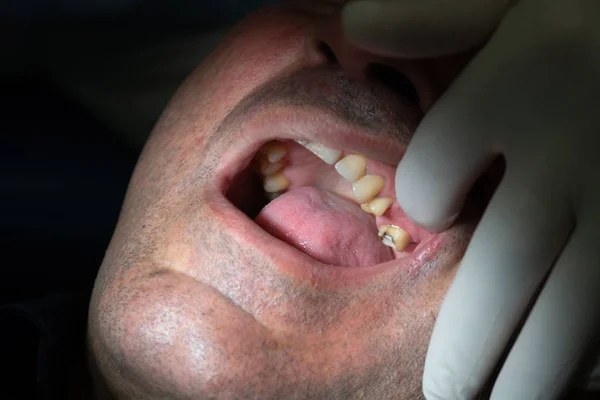 Professional dentist surgeon installing a dental implant