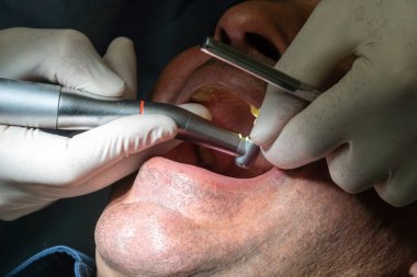 Diş implantı kuran profesyonel diş hekimi cerrahı