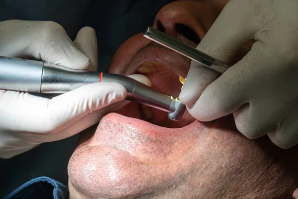 Professional dentist surgeon installing a dental implant