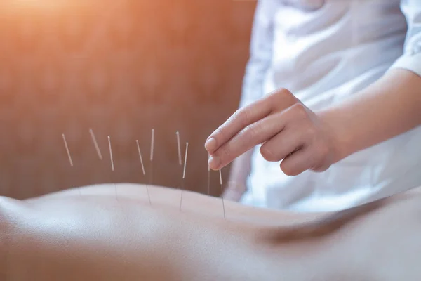Procedimento de acupuntura da agulha ; — Fotografia de Stock