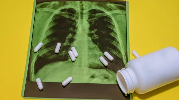 Una Radiografía Cerca Los Pulmones Pastillas Esparcidas Sobre Una Imagen —  Fotos de Stock
