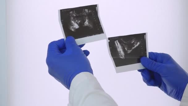 医生手里拿着前列腺的照片 一位治疗前列腺疾病的专家监护着一位医生 — 图库视频影像
