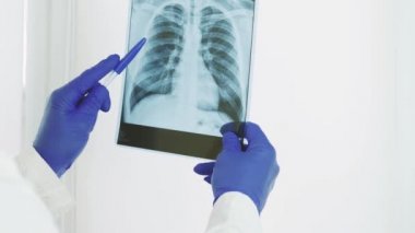 Bir sağlık çalışanı, bir doktor elinde bir röntgen tutuyor ve teşhis koyuyor, tıbbi görüş, zatürree ve akciğer ödemi.