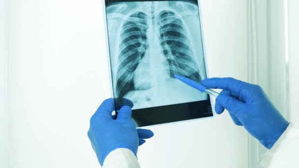 Der Arzt Diagnostiziert Seinen Patienten Untersucht Eine Röntgenaufnahme Der Lungen — Stockvideo