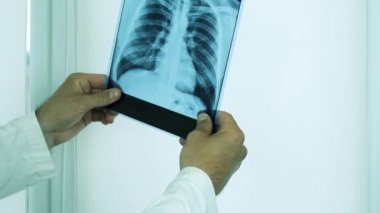 Doktor akciğerlerin röntgenine bakıyor, parmağını sorunlu bölgelere doğrultuyor, bir şey söylüyor, akciğerlerin zatürreesini teşhis ediyor. Yakından.