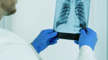 Ofisteki doktor kişinin akciğerlerinin röntgenine bakıyor, teşhis koyuyor, akciğerlerinin resmini inceliyor, ödem teşhisi koyuyor, tıp çalışanı dikkatlice akciğerlere bakıyor..