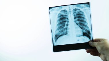 Beyaz arka plandaki bir adamın akciğerlerinin röntgeni. Doktor hasta için hastalığın analizini yapar. Akciğer ödemi kapanır.