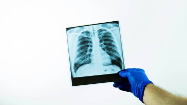 Beyaz arka planda bir doktorun elinde bir adamın röntgeni. Bir tıp çalışanı akciğer hastalığını inceliyor. Akciğer ödeminin enstantane görüntüsü..