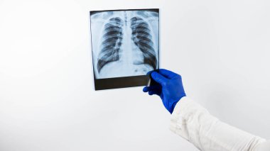 Beyaz arka planda insan ciğerlerinin röntgeni bir doktorun ellerinde, röntgen kırılması, resimdeki akciğerlerin gösterimi, hastaya akciğer ödemi teşhisi konuldu, yakın plan..