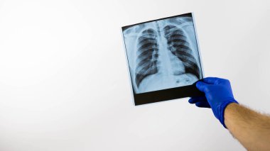 Akciğerlerin röntgeni, beyaz arka planda bir hastanede bir doktor tarafından inceleniyor, akciğerlerin zatürresi, bir sağlık çalışanının ellerinde röntgen filmi, yakın plan..