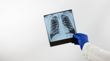 Beyaz arka planda bir doktorun elinde bir insanın akciğerlerinin röntgeni, akciğerlerin zatürresi, bir tıp uzmanı resimdeki akciğerleri gösteriyor, ödem, yakın plan..