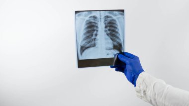 Bir doktor beyaz arka planda kişinin akciğerlerinin röntgenini çeker, bir tıp çalışanı elinde bir röntgen tutar ve bir klinikte hastaya teşhis koyar, akciğer zatürresi, ödem, yakın plan.