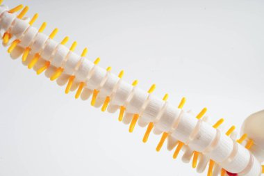 Omurga ve kemik, bel kemiği yerinden oynamış disk parçası, ortopedi bölümünde tedavi için model..