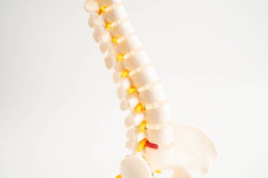 Omurga ve kemik, bel kemiği yerinden oynamış disk parçası, ortopedi bölümünde tedavi için model..