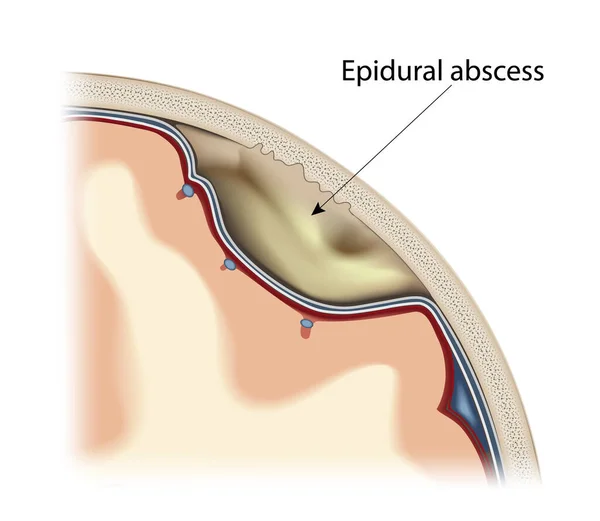 Vettore ascessi epidurali — Vettoriale Stock