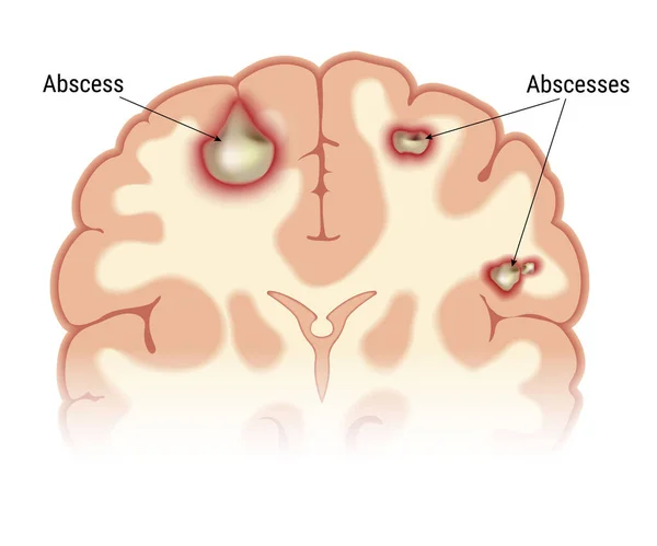 Vector intracerebral de abscesos — Vector de stock