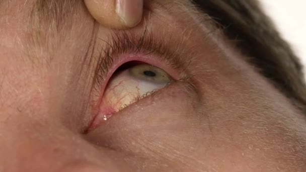 Közös szem fertőzés és inflamnmation, az ember csöpögő folyékony gyógyszer szeme — Stock videók